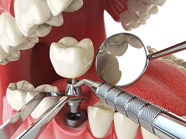 Best Emergency Wisdom Teeth Removal in Twin Lakes, VA